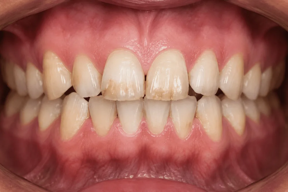 Cosmetic Smile Makeover Before